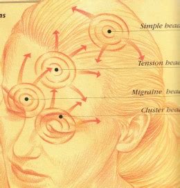 5 Types Of Headaches