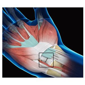 Wrist Ligament Injury | Academy Orthopedics L.L.C