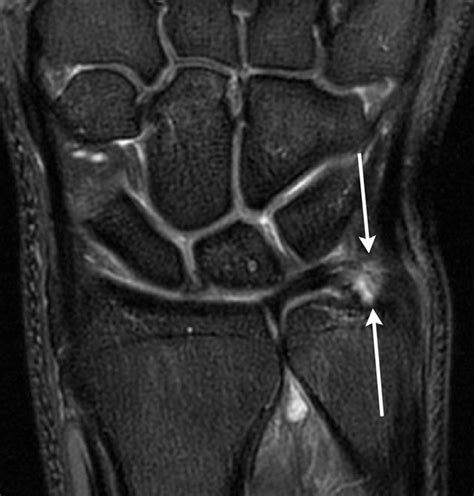 Wrist Ligament Anatomy Mri