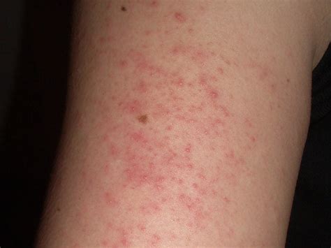 Breaking Out In Itchy Bumps : Why A Skin Rash May Be A Coronavirus Symptom According To Doctors ...