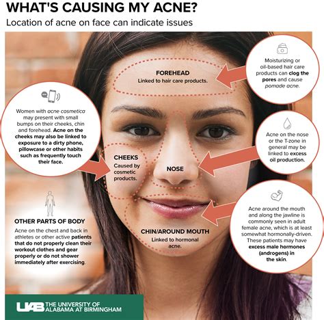 What is causing my acne? - News | UAB