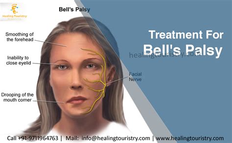 Healing Touristry: Bell's palsy – Symptoms, Causes and Treatment ...