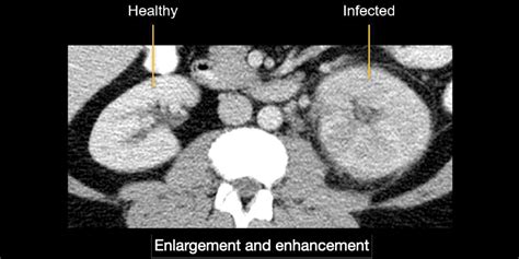 Abdominal CT: renal infections • LITFL • Radiology Library