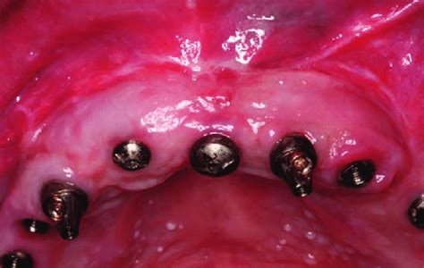 35 The mucogingival junction was positioned approximately 1012 mm... | Download Scientific Diagram