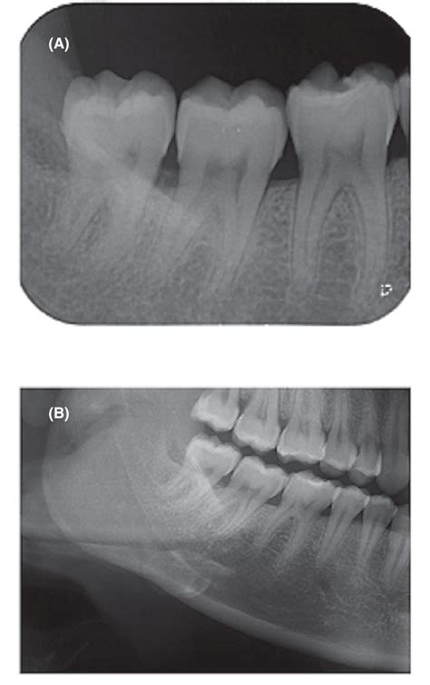 Periapical X Ray