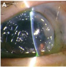 9 best images about Globe rupture after keratoplasty on Pinterest | Eyes, Globes and Fall