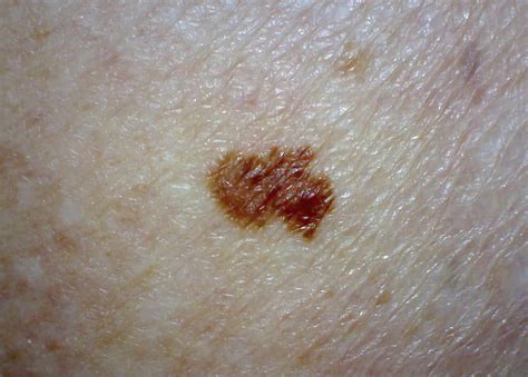 Early stage melanoma cancer pictures | Symptoms and pictures