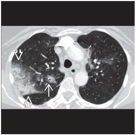 Cryptogenic Organizing Pneumonia | Radiology Key