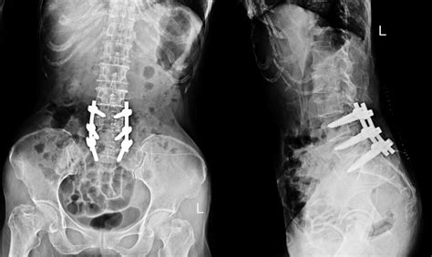 Lumbar Fusion - Neurosurgery of St. Louis | STL Brain & Spine Doctors