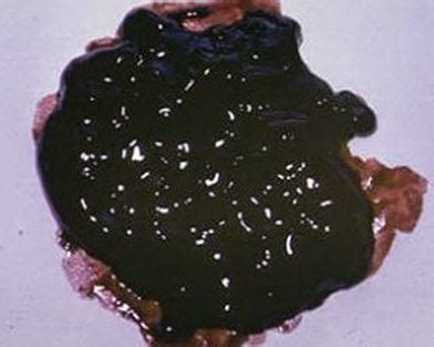 Black Stool Pictures, Causes, Meaning, Symptoms, Treatment