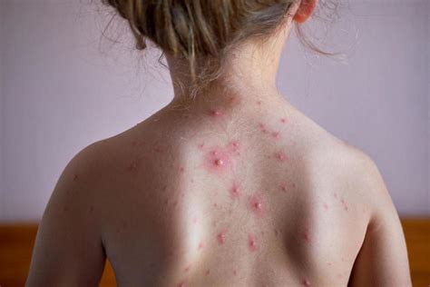 Worst Chicken Pox Outbreak in 20 Year Hits NC | Feb. 27, 2021, 10:32 a.m. - Vaccine Awareness Center