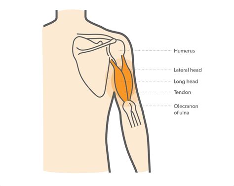 What is Triceps Tendonitis & How to Manage Elbow Pain? - Upswing Health