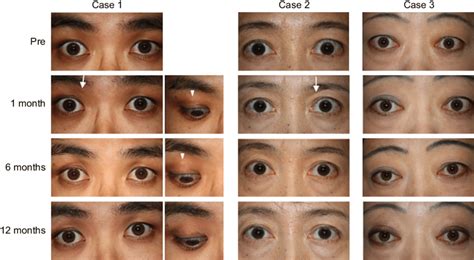 Case 1: The right eye was treated. Before treatment, upper eyelid... | Download Scientific Diagram