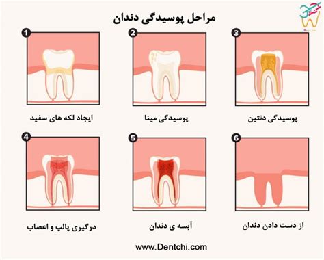 مراحل پوسیدگی دندان و درمان آن - دنتچی