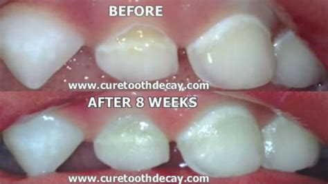 Tooth Decay is Heal-able - Simply Health Chiropractic | St. George, Utah Chiropractor