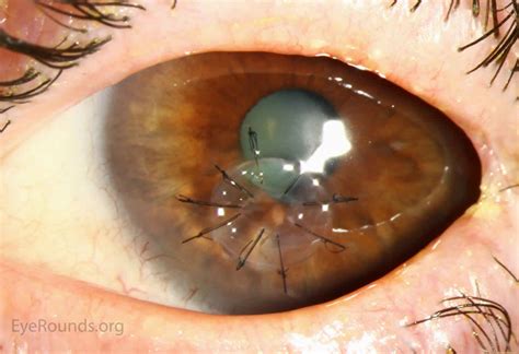 Cornea transplant types, success rate, vision after transplant, rejection, complications