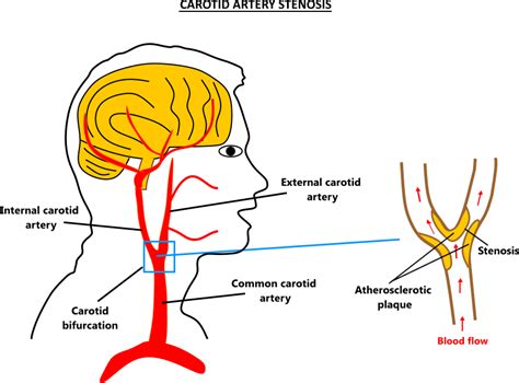 Carotid stenosis illustration