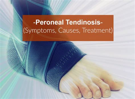 Peroneal Tendinosis Symptoms Causes Treatment | Porn Sex Picture