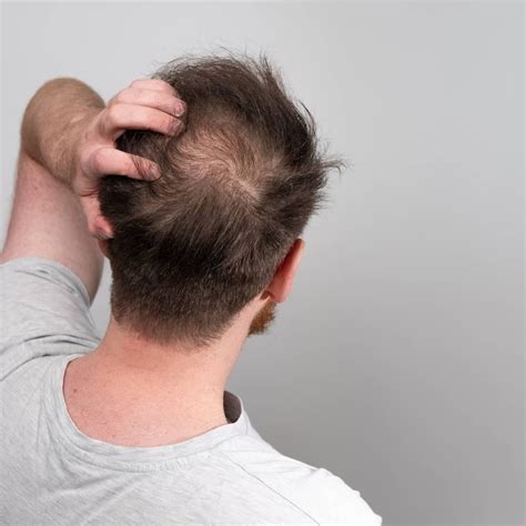 Male Pattern Baldness (Androgenic Alopecia): Stages, Treatment | atelier-yuwa.ciao.jp