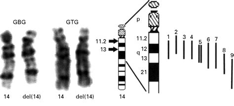 De novo deletion (14)(q11.2q13) including PAX9: clinical and molecular findings | Journal of ...