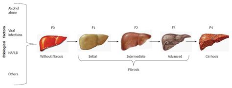 Genetic, metabolic and environmental factors involved in the development of liver cirrhosis in ...