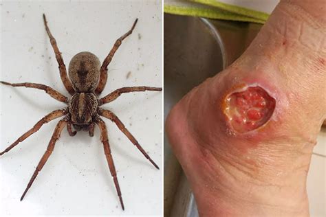 The worst spider bite pictures including the Brown Recluse and Black Widow - Mirror Online