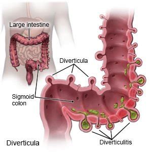 What Foods Can Aggravate Diverticulitis | Deporecipe.co