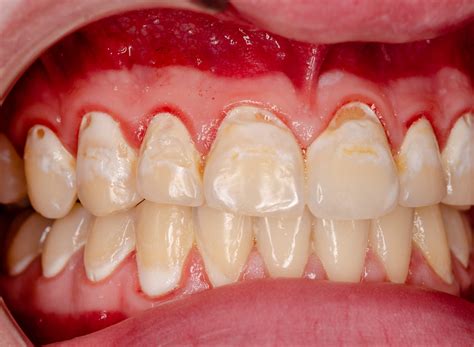 Tooth Remineralization - Beacon Hill Dental Centre