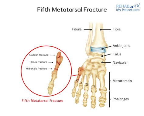 Fifth Metatarsal Fracture | Rehab My Patient