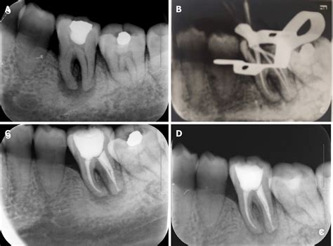 Periapical X Ray