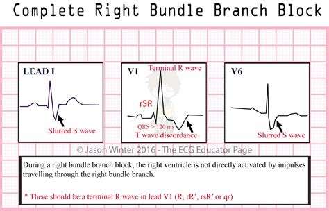 ECG Educator Blog : Bundle Branch Blocks