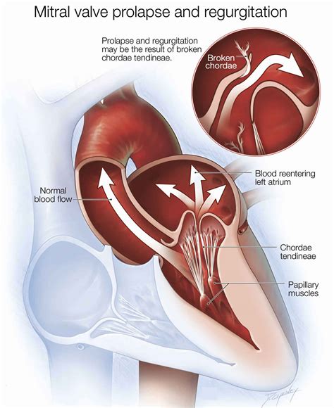 Mitral valve regurgitation causes, symptoms, diagnosis, treatment ...