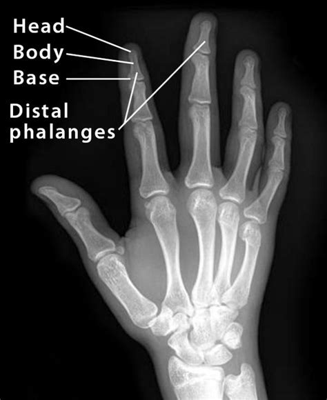 Distal Phalanx