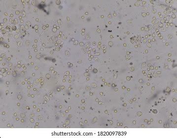 Rbc Wbc Bacteria Urine Find Microscope: foto stock (editar agora) 1820097839