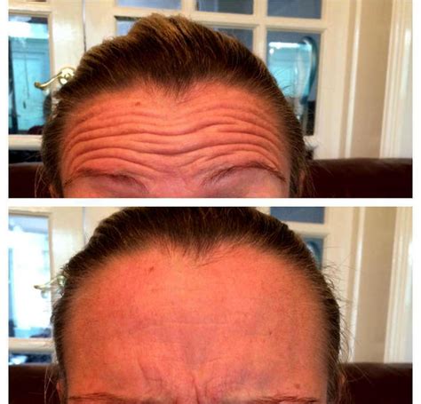 Botox Forehead Wrinkles Before And After Pic » Facial Injections: Info, Prices, Photos, Reviews, Q&A