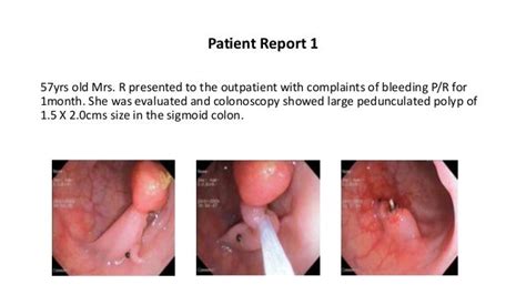 Endoscopic removal of colonic polyps