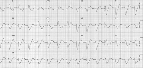 Hyperkalemia Ekg