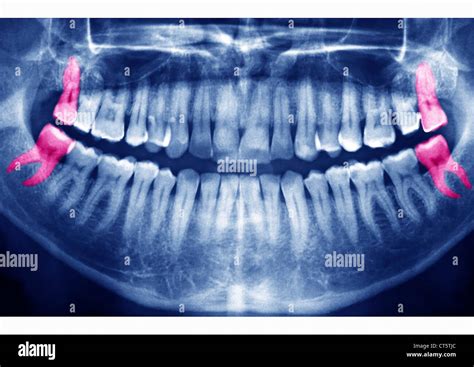 Wisdom teeth x ray hi-res stock photography and images - Alamy