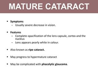 Cataract | PPT