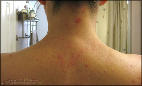 allergic reaction to shampoo - pictures, photos