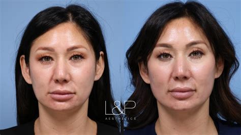 Facial Fillers Before and After Photo Gallery | Palo Alto & San Jose, California | L&P Aesthetics