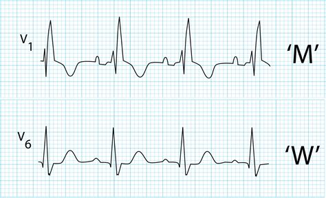 R wave • LITFL • ECG Library Basics