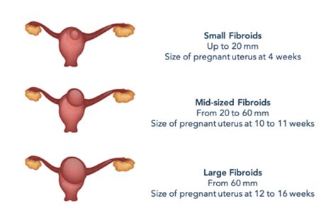 Fibroid Belly Bulge & Weight Gain Pictures