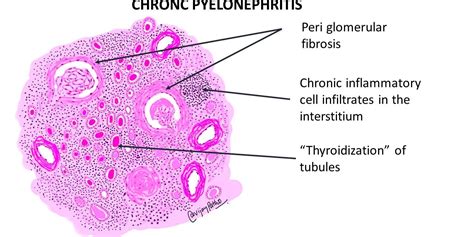 CHRONIC PYELONEPHRITIS - Pathology Made Simple