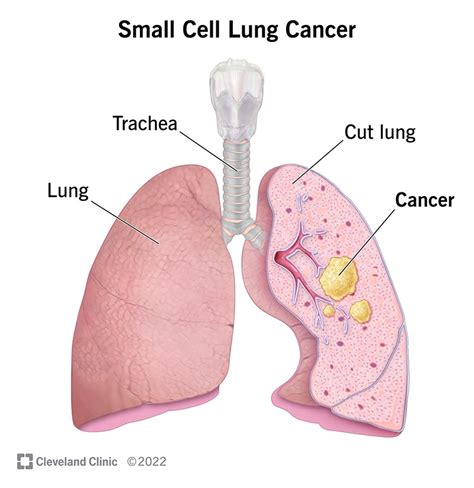 Stage 2 Of Lung Cancer