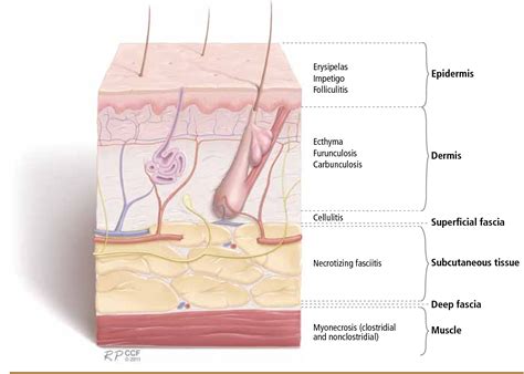 [PDF] Skin and soft-tissue infections: Classifying and treating a spectrum | Semantic Scholar