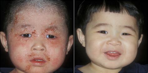 Eczema Before And After