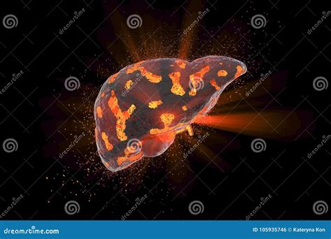 Liver Damage Infographic Diagram Cancer Disease Anatomy. Liver Damage Organ Tissue Hepatic ...