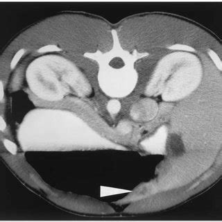 CT scan of abdomen showing liver laceration (arrowhead). | Download Scientific Diagram