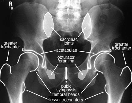 Radiology Anatomy Images : Pelvis x-ray anatomy